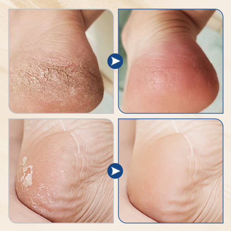 🔥 HOT SALE 🔥 Hydrating & Anti-Cracking Foot Cream – Intensive Moisture, Repairs Dry & Cracked Heels, Softens Rough Skin ✨