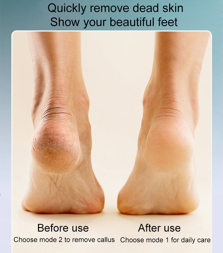 🔥Hot Sale💕Rechargeable Electric Foot Callus Remover